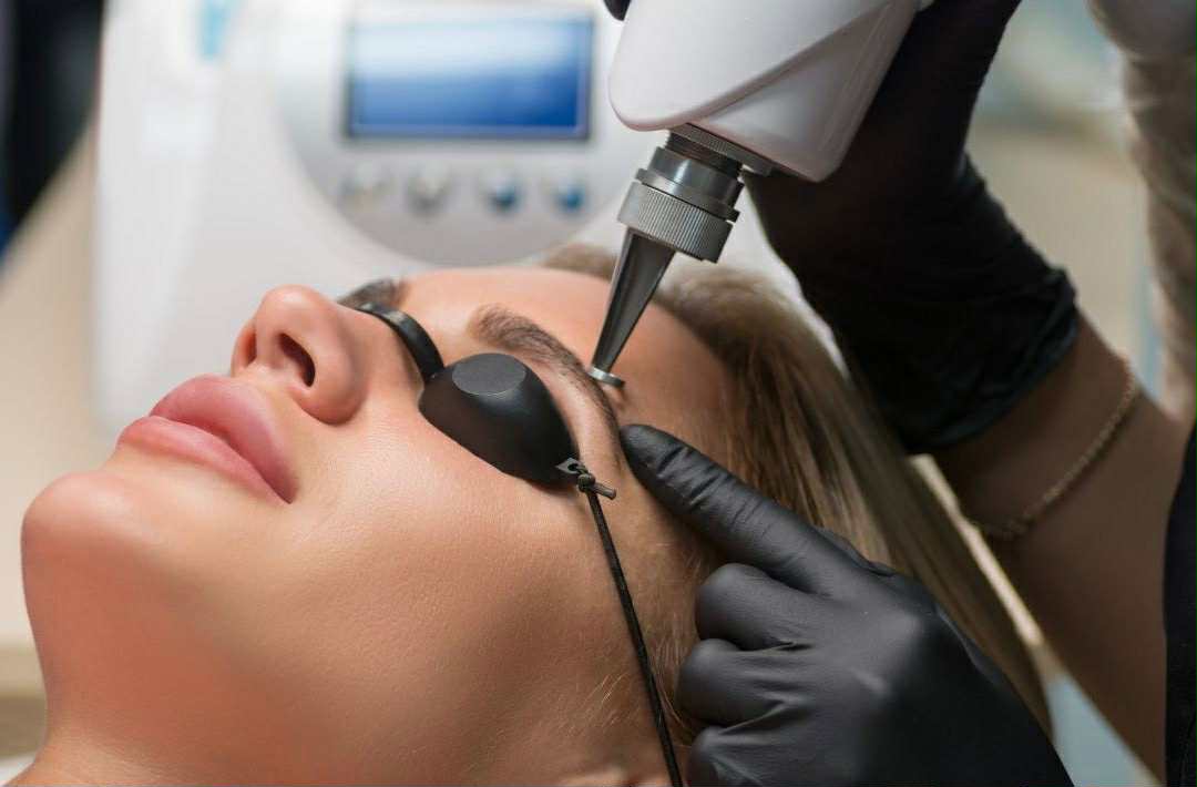 Laser PMU Removal treatment at Studio 11 in Windsor
